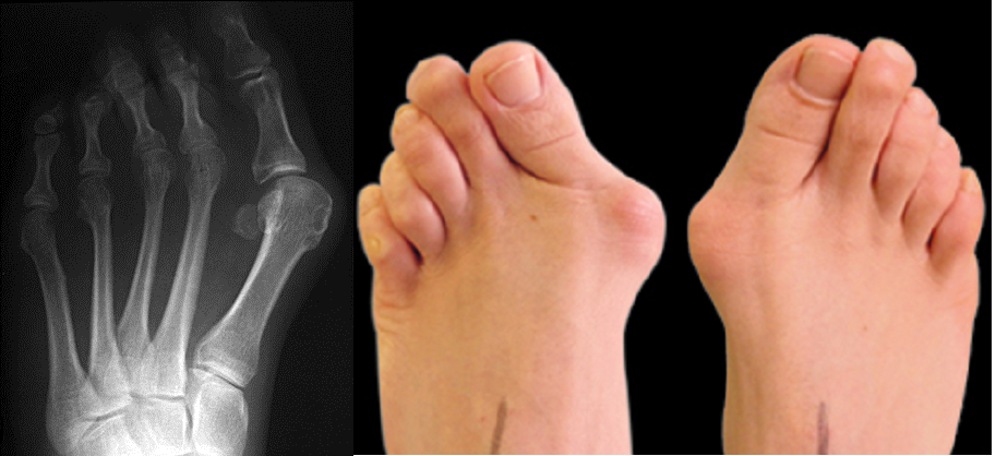 اصلاح hallux valgus کودکان با کمک اسپیلنت اورفیتی